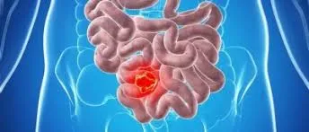 BAĞIRSAK HASTALIKLARI  20-40 YAŞ ARALIĞINDA DAHA SIK GÖRÜLÜYOR